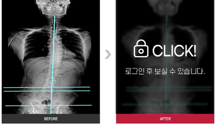 허리 통증 및 디스크 탈출증 전후 
