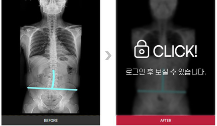 골반, 어깨 통증 호전 전후사례
