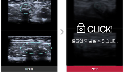 허벅지 근육 파열 석회화 치료 전후사례