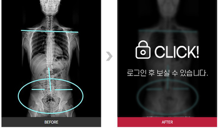 골반, 어깨 통증 호전 전후사례