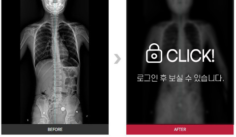 척추측만증 전후사진