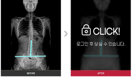 척추, 골반 교정 전후 사례