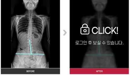 골반 통증완화 전후 사진