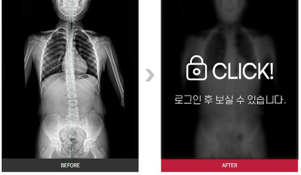 척추측만증 전후사진