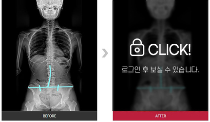 골반, 척추 통증 완화 전후