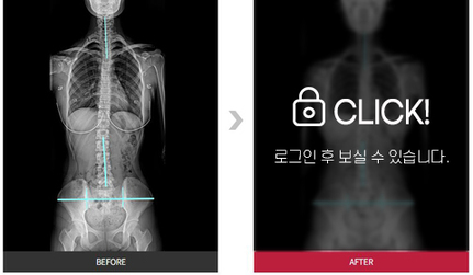 척추, 골반 교정 전후 사례