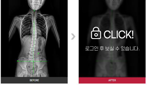 척추측만증 전후사진