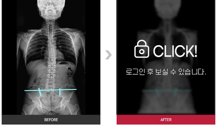 목, 척추, 골반 교정 전후 사례