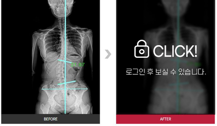 목, 허리통증 전후사진