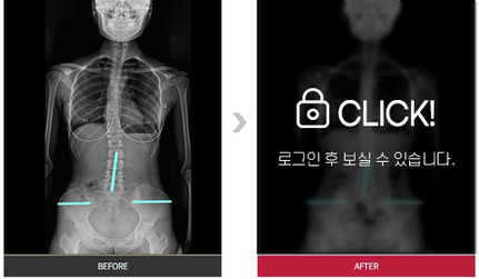 척추, 골반 교정 전후 사례