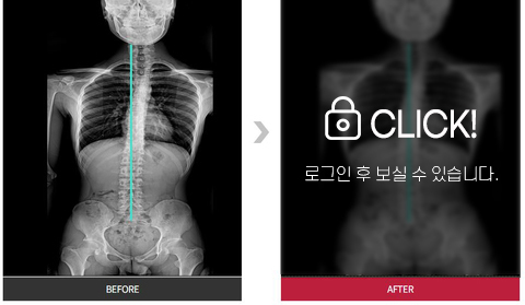 턱관절 및 목통증 전후 사진