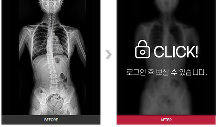 척추측만증 전후사진