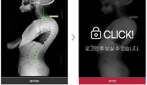 턱관절 및 목통증 전후 사진