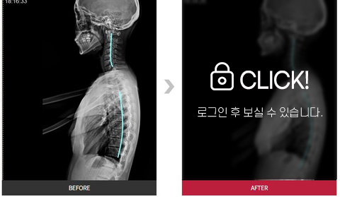 목 & 등 통증 전후 사진